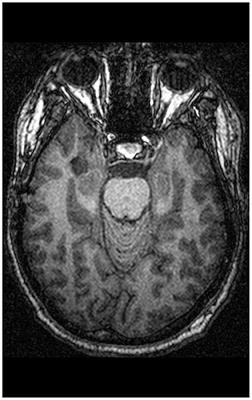 Case of Asperger's Syndrome and Lesion of the Right Amygdala: Deficits in Implicit and Explicit Fearful Face Recognition